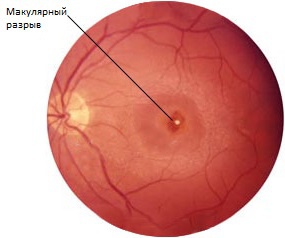 Разрыв сетчатки глаза лечение